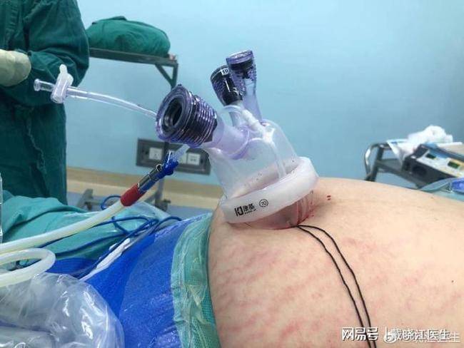 切胃减肥术:切了胃会不停地瘦吗