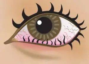 眼睛也会得"结石",这三种情况要注意了!