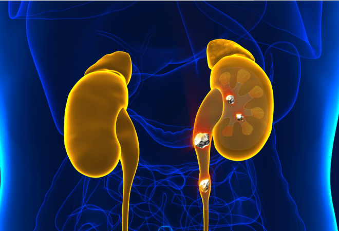 肾脏病排名_慢性肾脏病图片(2)