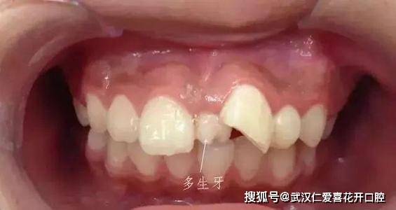 换牙年龄 e887dd4fd9204726b830e9b175dc6b62.jpeg