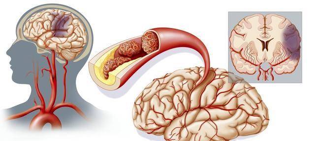 颈动脉有了斑块 对哪里影响最大 有了斑块后要注意什么 了解下 疾病