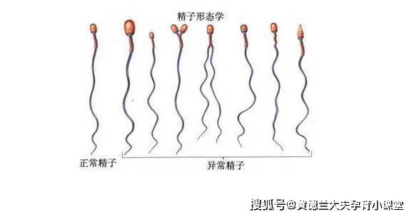 精子畸形也叫畸形精子,是指头,体,尾的形态变异,头部畸形有巨大头,无