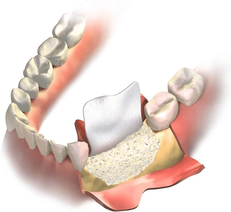 种植牙补骨粉有无痛苦和风险