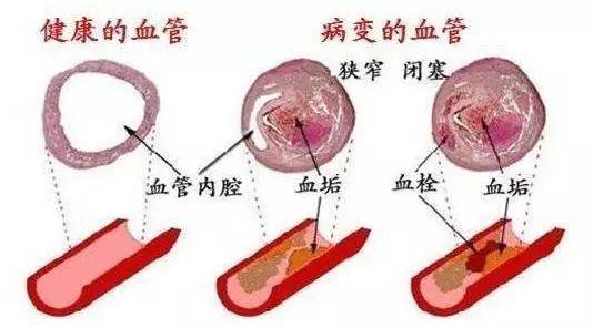什么情况下需要做血管造型 3cefd38dcb174e3d988c89081a70b774.jpeg