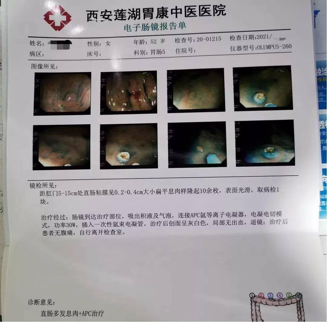 电子肠镜报告单肠镜检查结果所示:患者距肛门5-15cm处直肠粘膜见0.