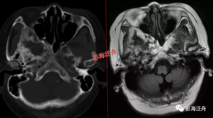 蝶骨的病變在mr上識別起來更為困難,因為蝶骨位於顱底部,此處骨骼