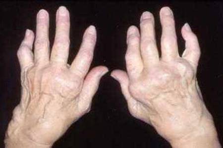 很多人,关节疼痛时就会忍着,或是医生让你治疗,你不愿意治疗.