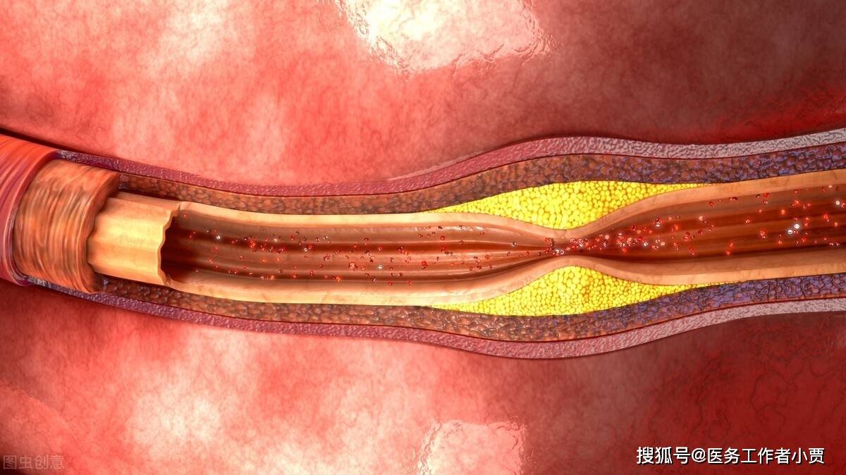 中老年心腦血管疾病的預防及治療,這次醫生統統告訴你