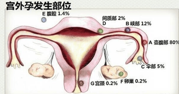 备孕的夫妻注意了 这些常识要知道 教你认识宫外孕和宫外孕早期会出现的症状 女性