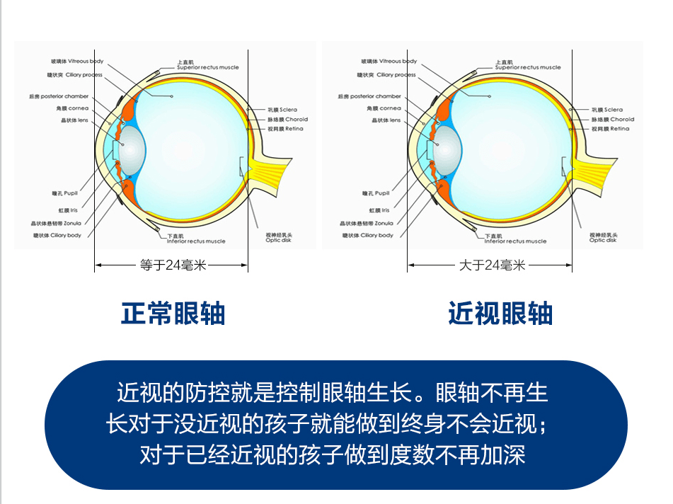 什么是单纯性近视 04bf22a379cb4283ba248a4b6501dd8a.png