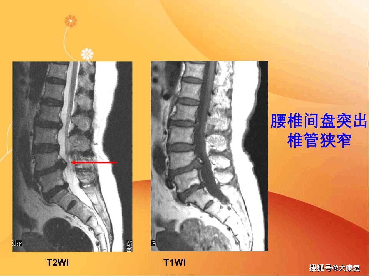 脊柱常見疾病的mri診斷