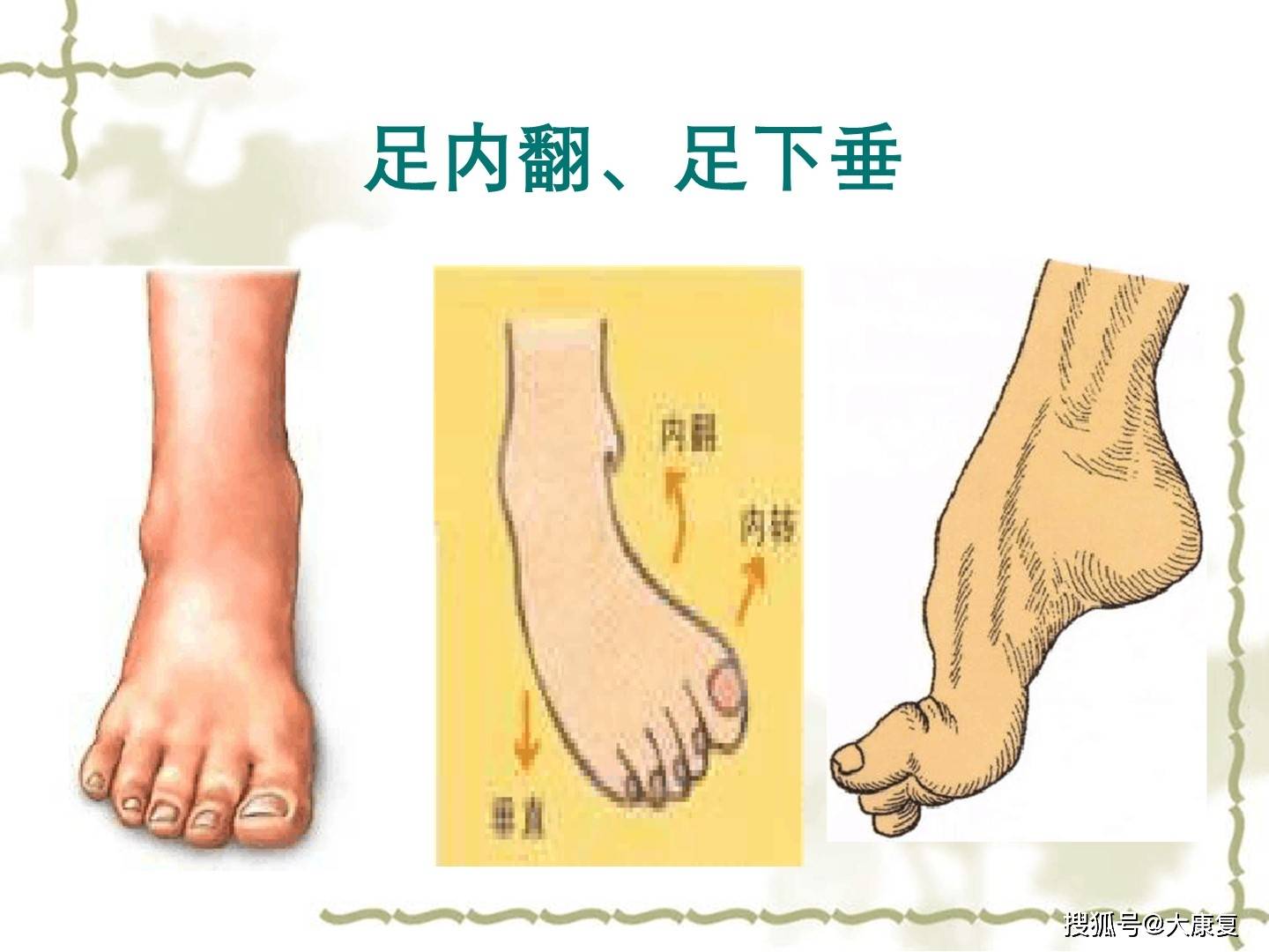 脑卒中后足内翻,下垂