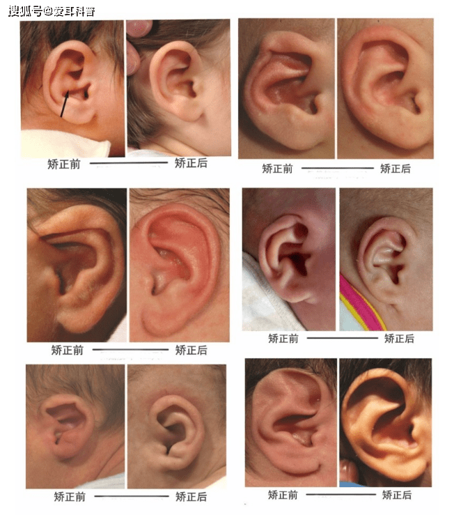 耳朵类型图片