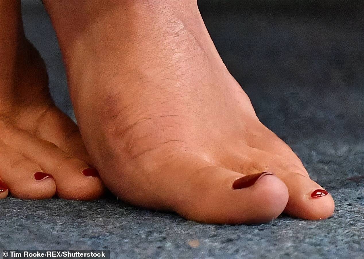 大家也不禁感慨,她因为常年穿高跟鞋让自己的整个脚趾头都变了形,甚至