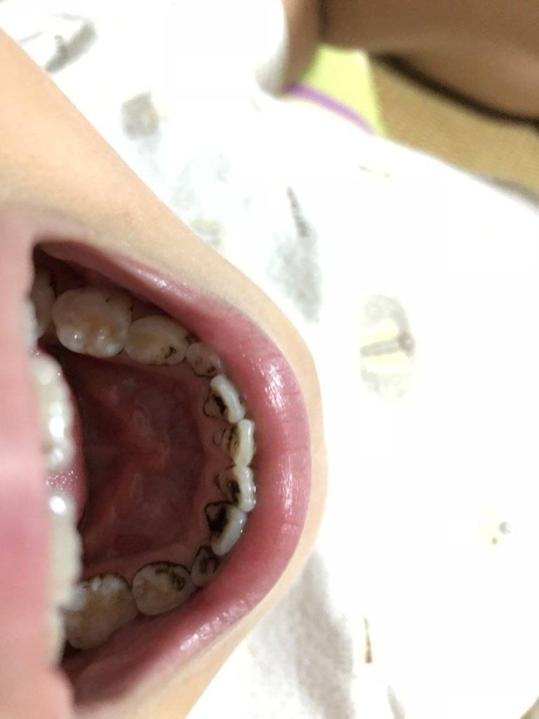 咬骨头都可以,那么牙齿的主体,还有一个厚厚的牙本质,牙釉质最外层