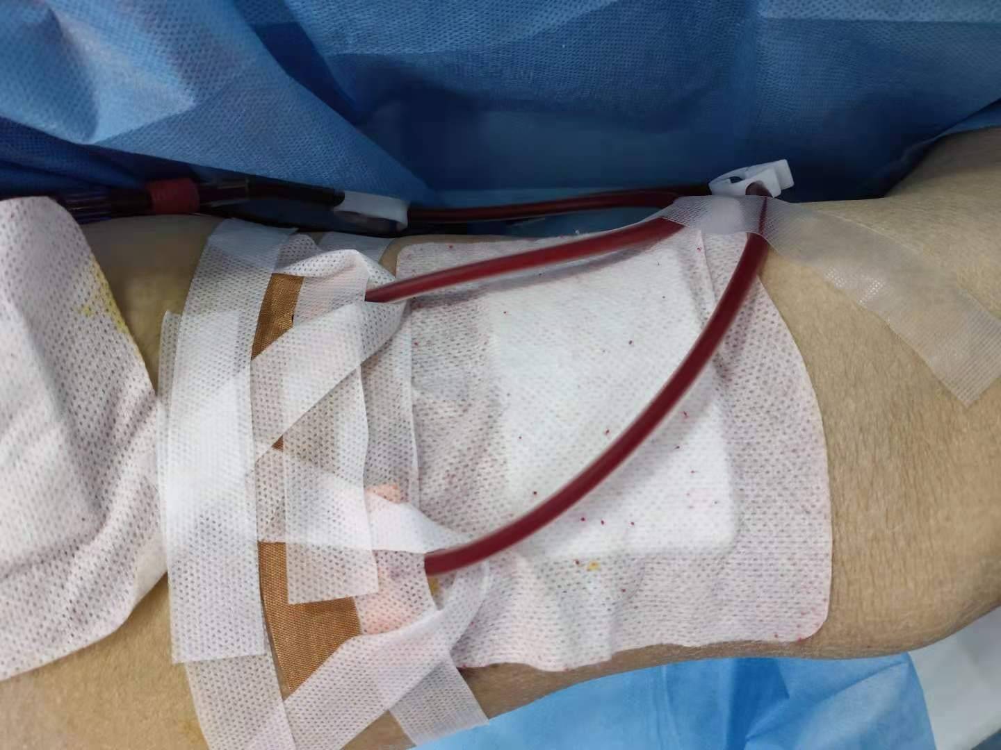 西安交大一附院首例下肢人工血管内瘘术成功实施