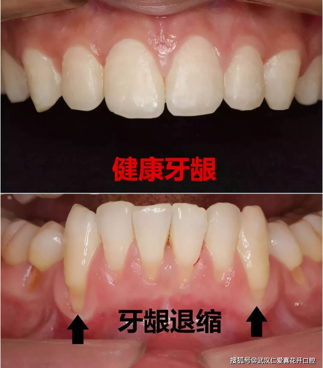 为什么牙龈会萎缩,该怎么办?给牙龈美个容吧_牙齿
