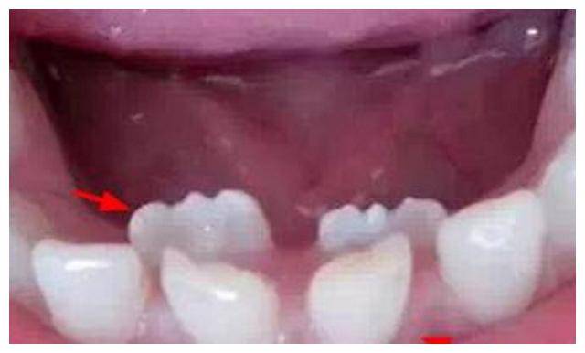 【乳牙滞留】儿童乳牙滞留的原因_乳牙滞留怎么办