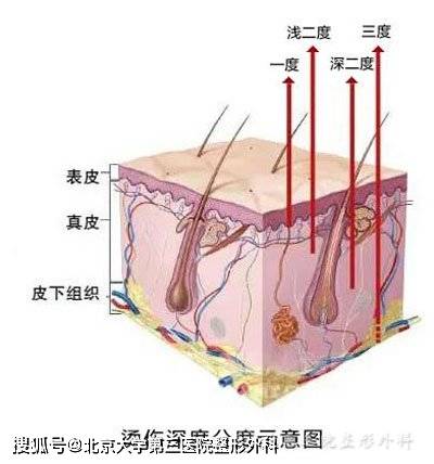 烫伤后怎么减少疤痕产生 二 处理