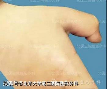 【家长必看】预防儿童烧烫伤后疤痕