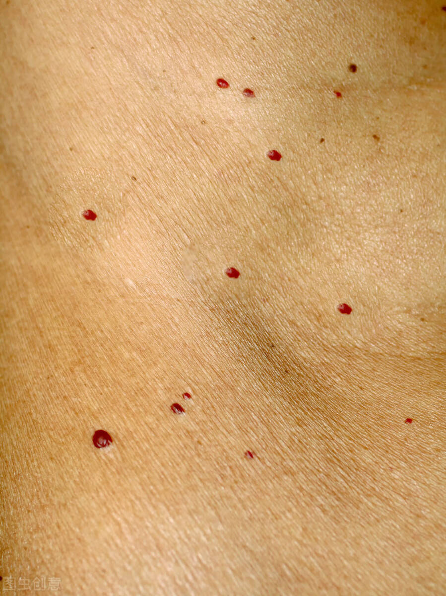 长红痣,是肝病的标志吗?在中医眼中,还有这2种原因,不妨看下_血管
