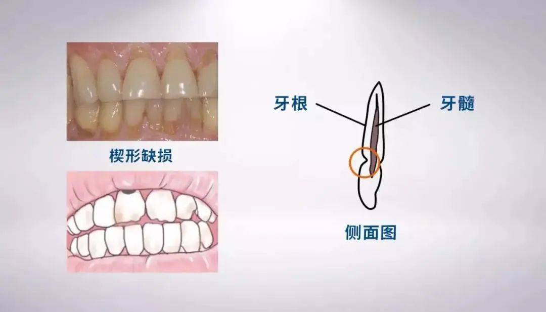 牙齿敏感酸痛可能是被刷出楔状缺损