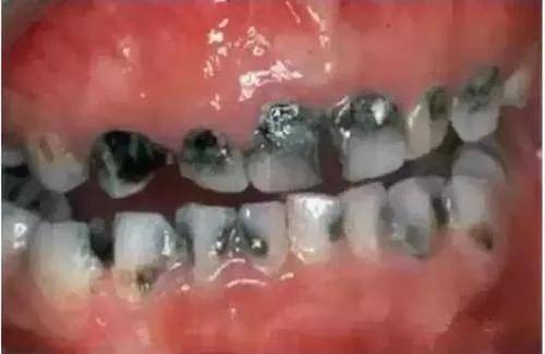 但是,现在越来牙齿发黑的问题越来越年轻化,许多儿童牙齿开始变黑