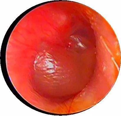 耳剧痛 需警惕 当心大疱性鼓膜炎 全身