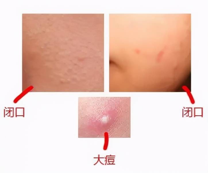怎么才能不长闭口粉刺 854ab6c1e9094e4da2764a7168ba7b9c.jpeg