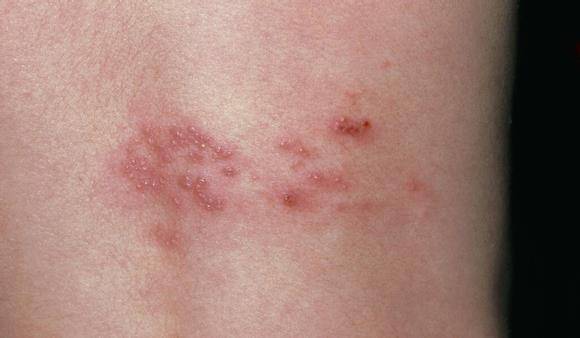 hpv感染红疹子图片图片