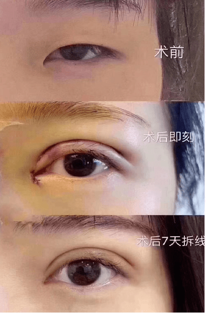 听医生跟你讲:什么是眼综合?能达到什么样的效果?_手术