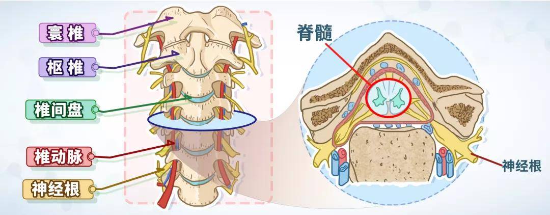 郴州骨科醫院為您科普手麻手木頸椎痛神經根型頸椎病