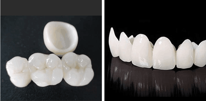 都说全瓷牙好究竟好在哪里