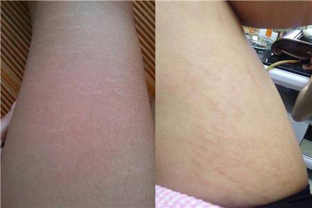 肥胖纹瘦了会掉吗 9a35236b63b6428db800e271f97bf5ce.jpeg