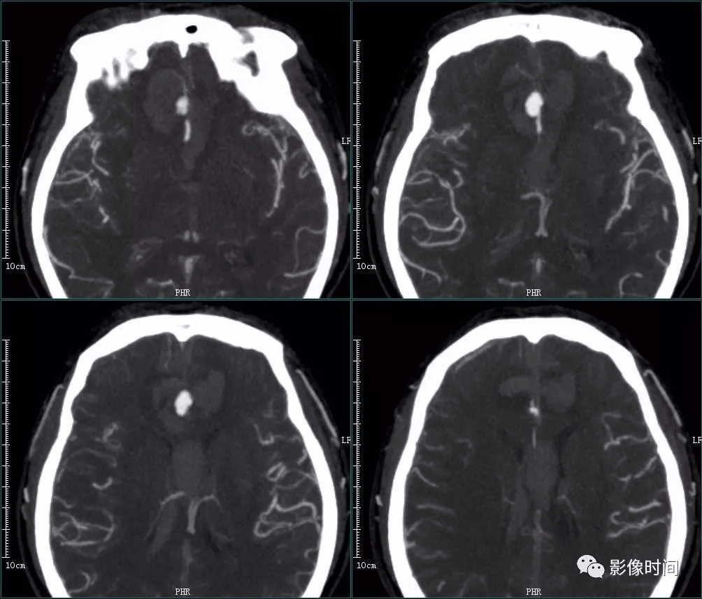 8 個病例帶您一起復習顱內動脈瘤這些知識_部分