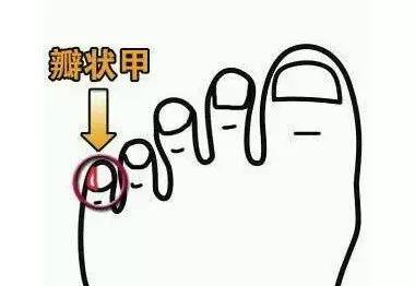 脚小拇指边长茧怎么办