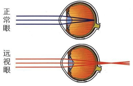 遠視,指遠處物體經過眼部屈光系統後,未成像在視網膜上,而是成像在