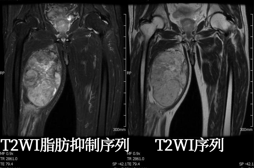 腹膜後病例來一波脂肪肉瘤夠典型不