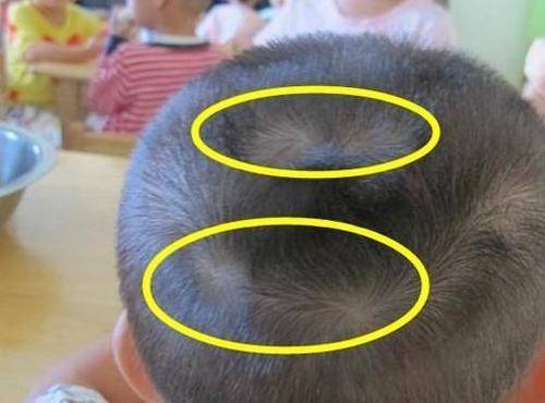 为什么有的孩子头上有"2个旋"?代表什么意思,父母要知道