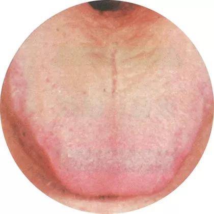 干货分享 || 舌诊大全,建议收藏!_舌苔