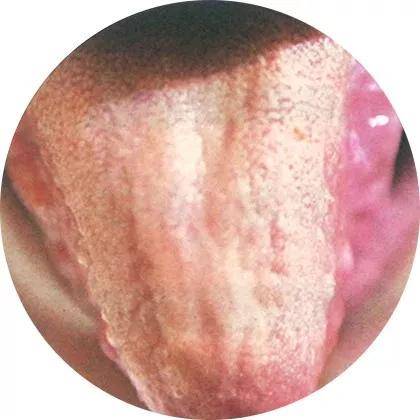 干货分享 || 舌诊大全,建议收藏!_舌苔