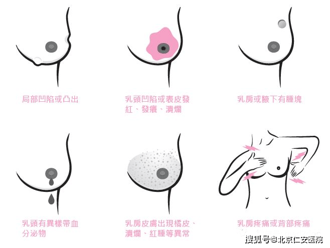 乳房出现这几种变化要留意了 肿块