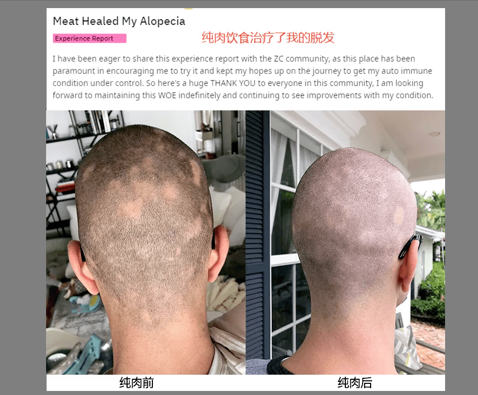 沈梦辰突然斑秃很多人不知道背后的原因什么是斑秃