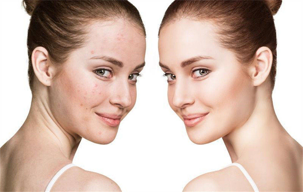 如何改善水油失衡皮肤问题?