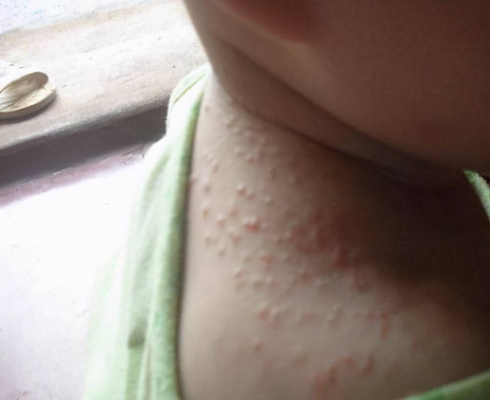 夏季是湿疹高发期？不用担心，记住这几个穴位就能解决  长湿疹不一定是坏事