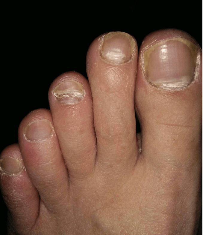 小脚指甲裂成2瓣的人是什么来历,是纯种汉族人吗?说出来别不信_大槐树