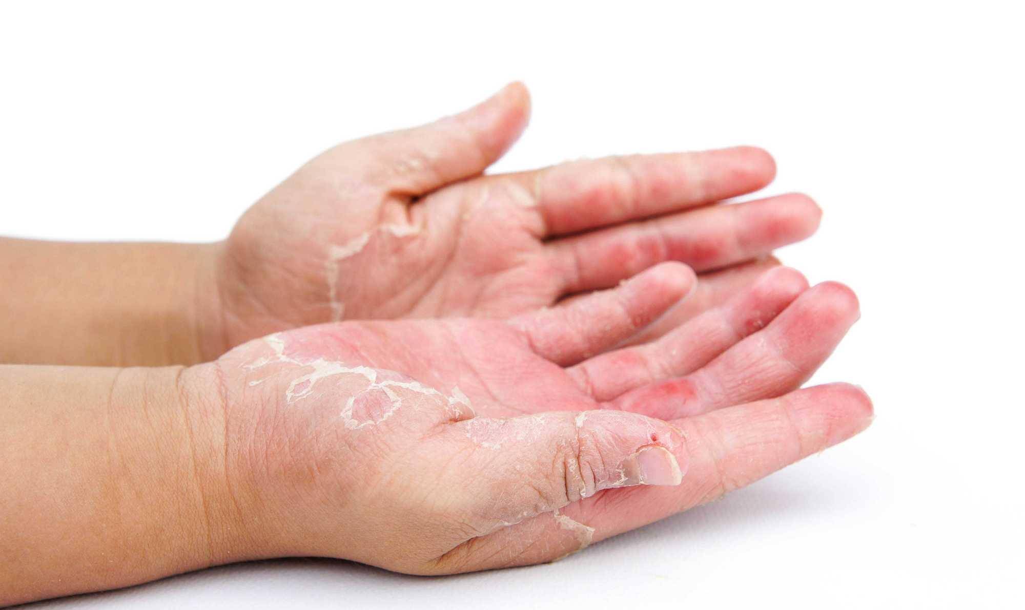 手指长“小水泡”还伴有“脱皮”是什么情况?