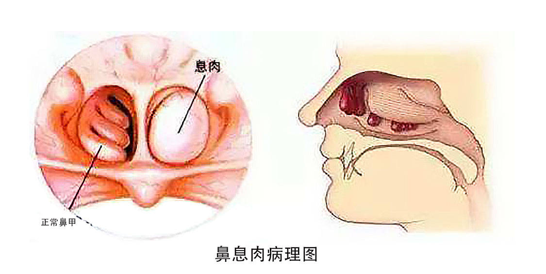 可為單發性或為多發性,多見於上頜竇,篩竇,中鼻道,中鼻甲等處.