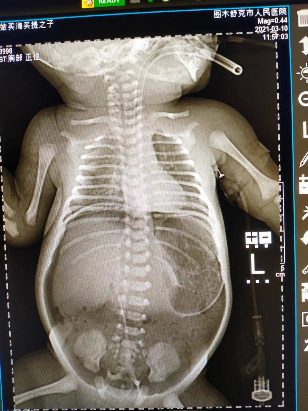 前后方联动多学科合作出生3天新生儿胃穿孔8厘米第一师医院生死急救获