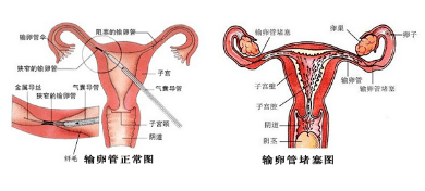 檢查發現輸卵管堵塞,我還能懷上孩子嗎?